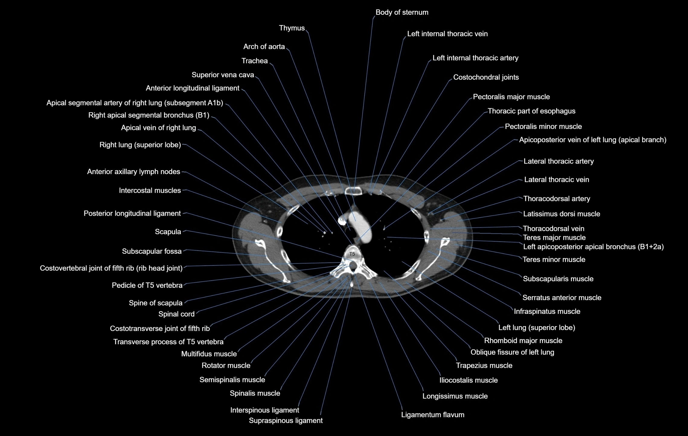 CT chest (thorax) soft tissue window labelled axial cross sectional anatomy radiology image-00034.webp